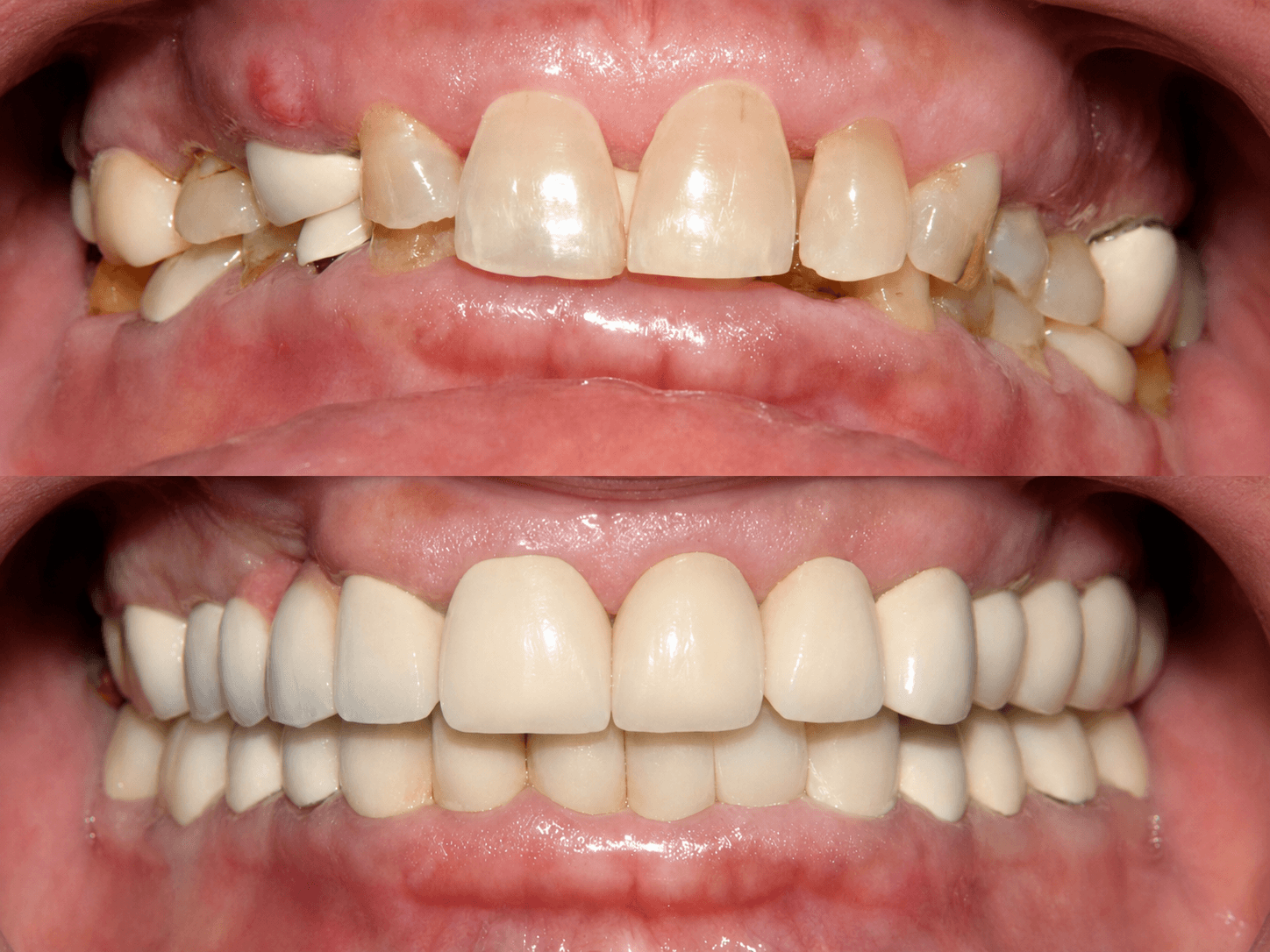 Full Mouth Rehabilitation image