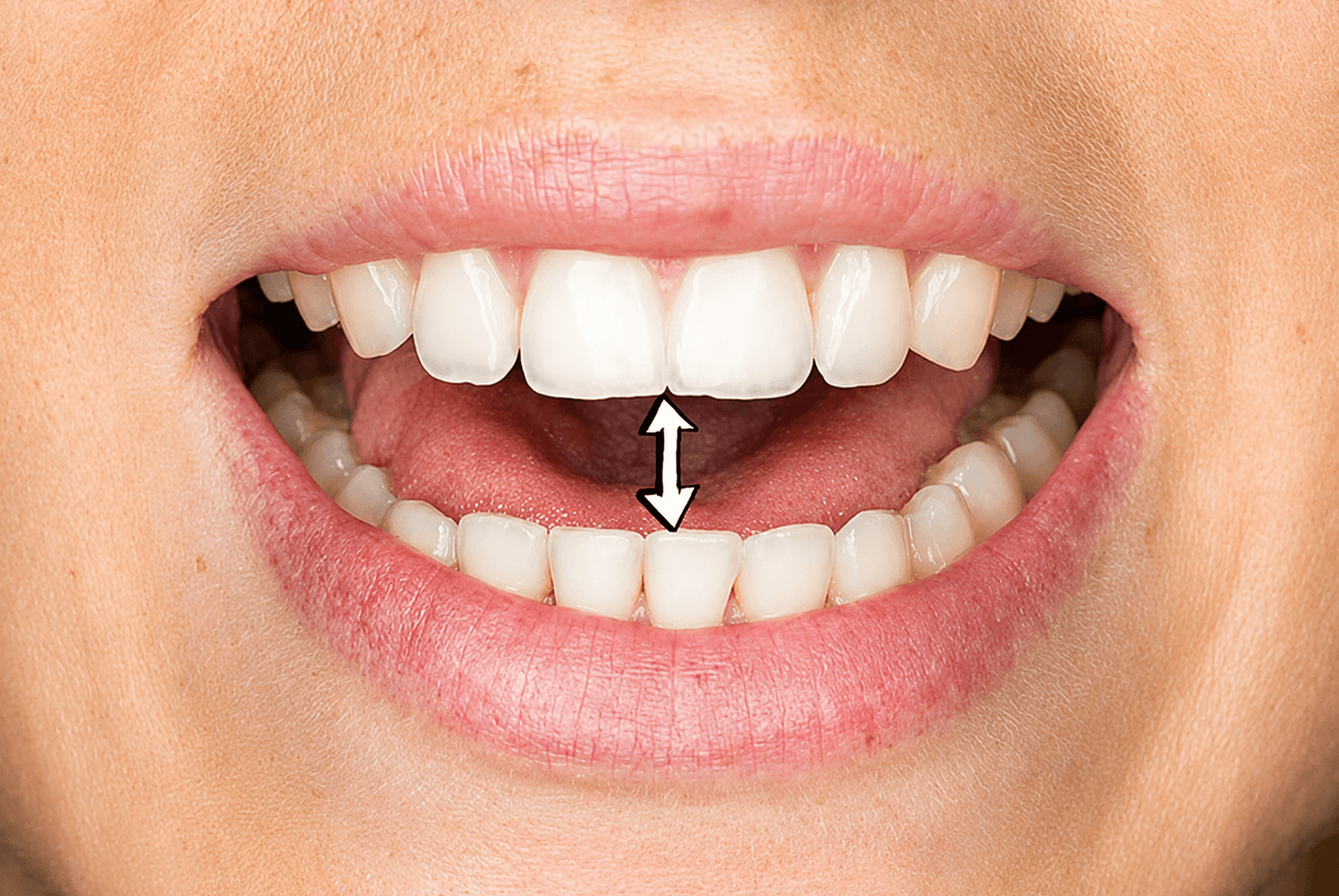 Restricted Mouth Opening Treatments image