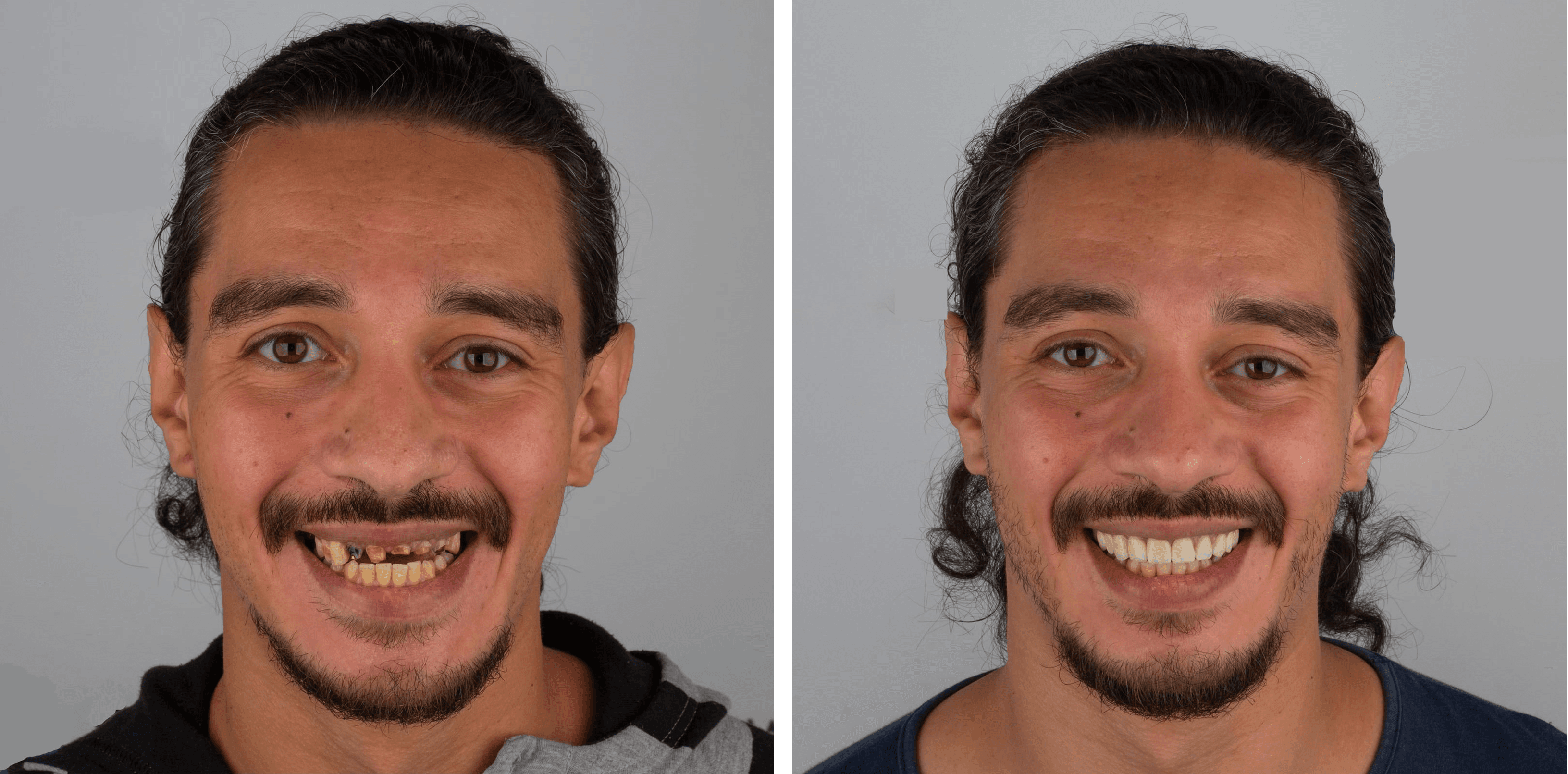 Smile Designing result 1