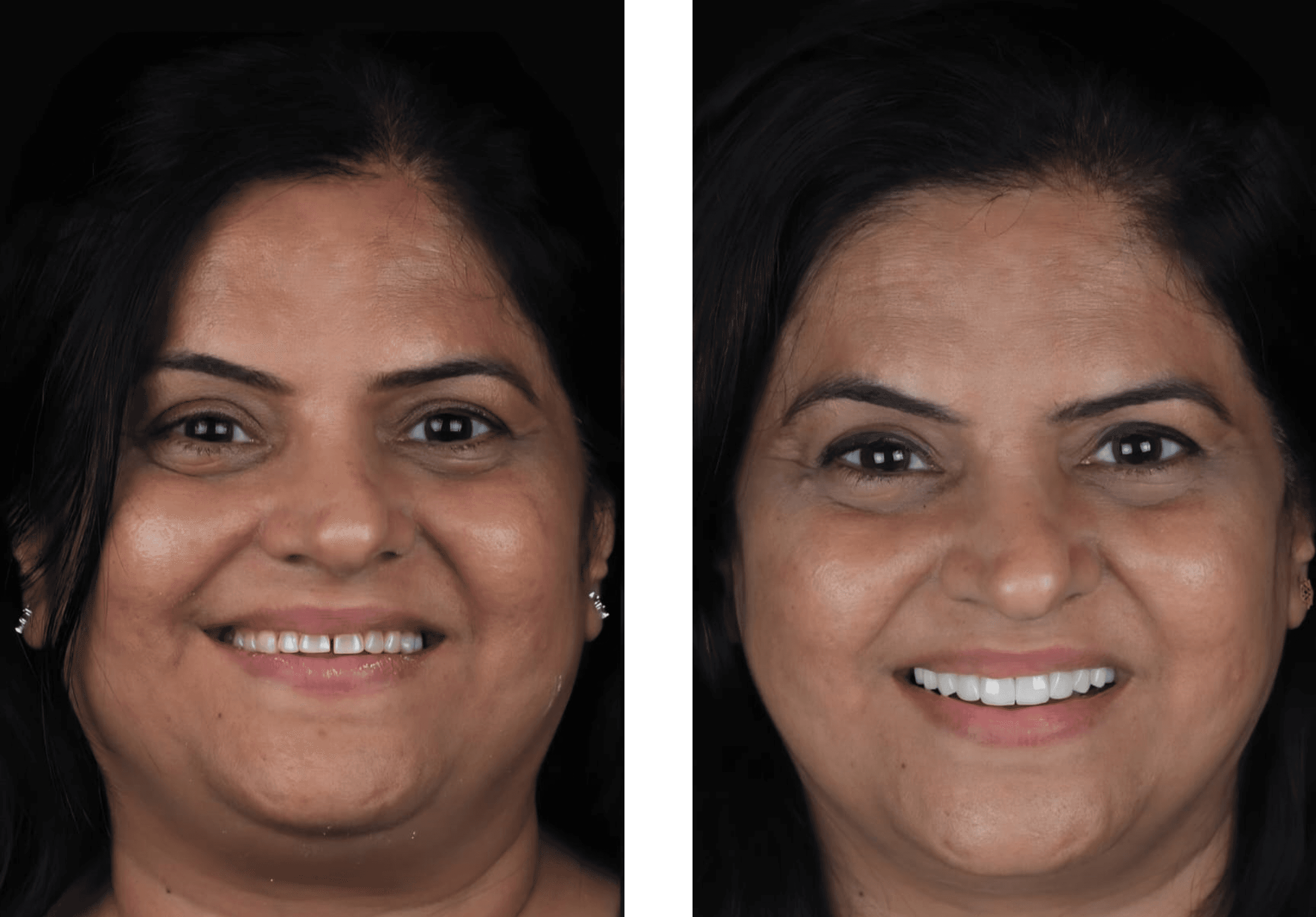 Smile Designing result 2