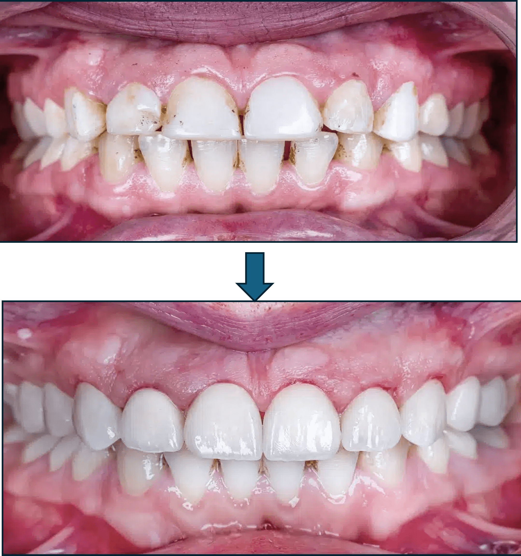 Smile Designing result 4