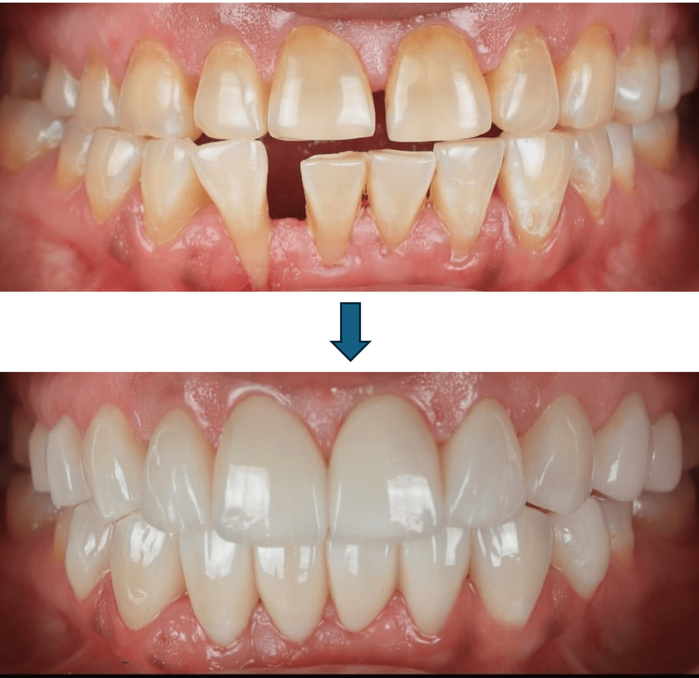 Smile Designing result 6