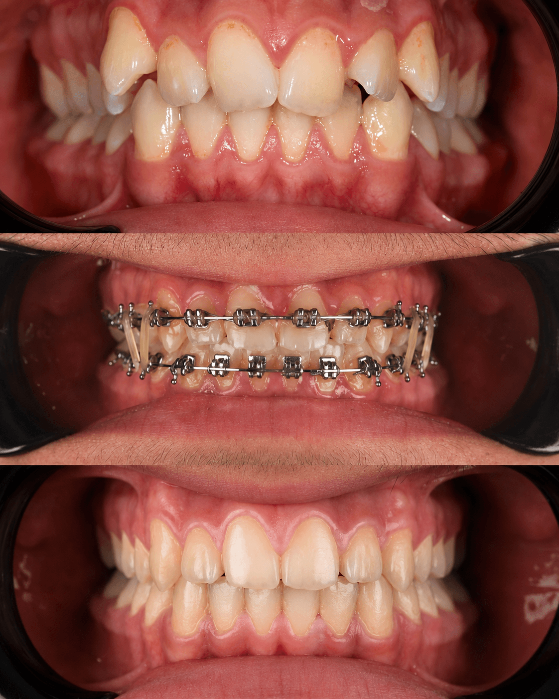 Braces Treatment image