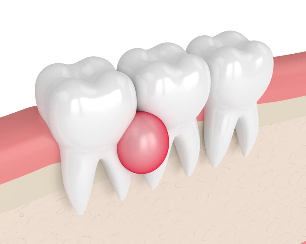 Cyst Removal image