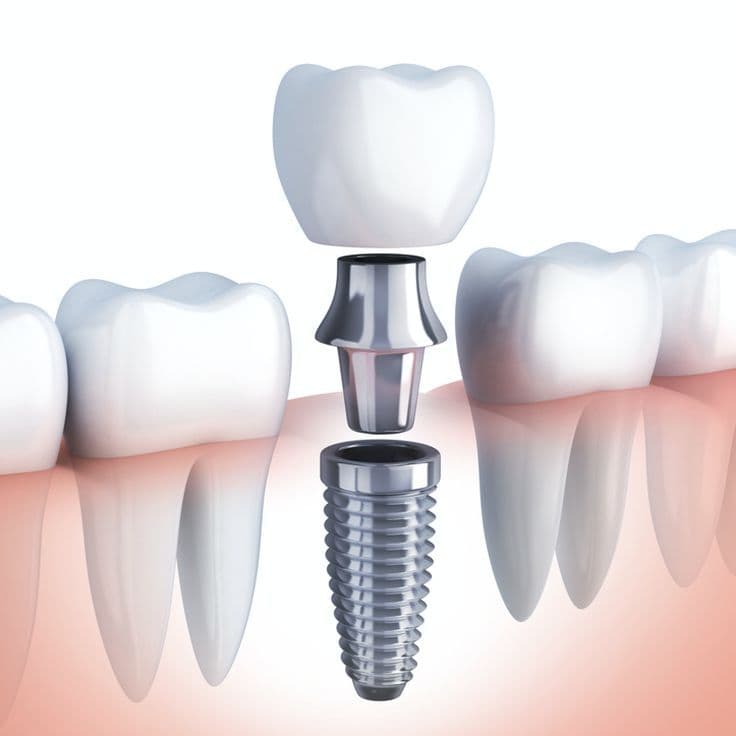 Dental Implant image