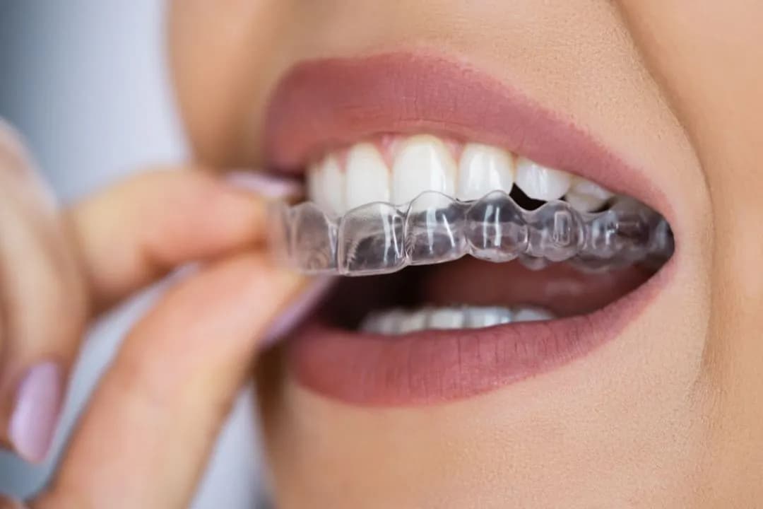 Invisible Aligners image