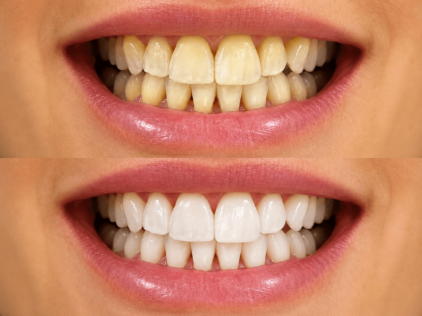 Teeth Whitening image