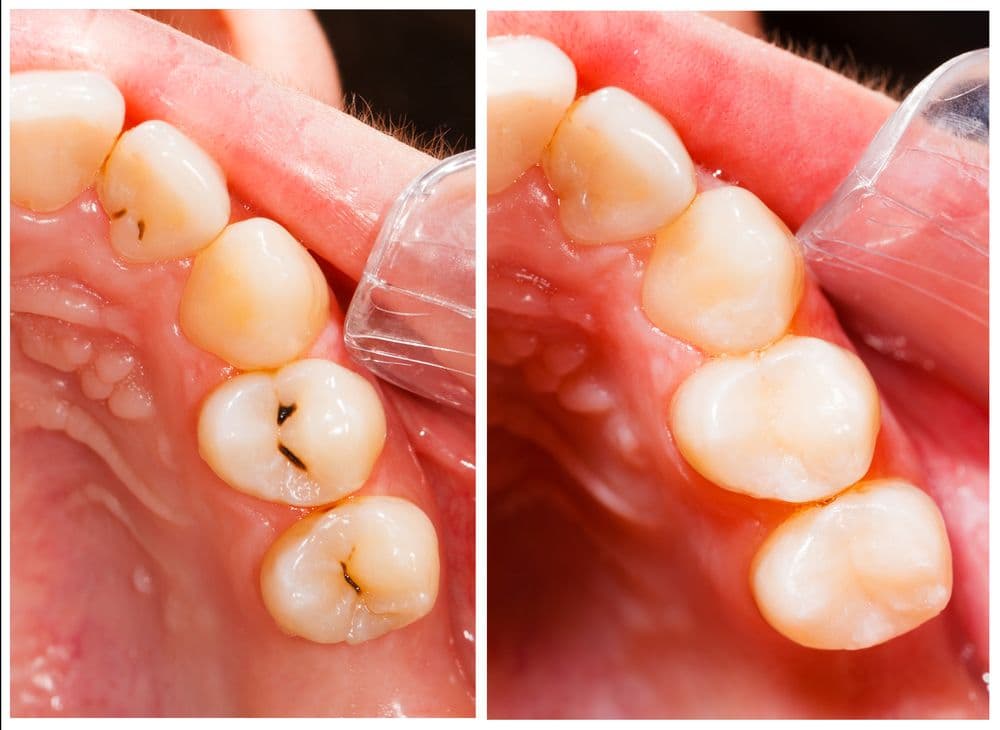 Tooth-Colored Filling image